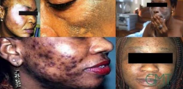 Bénin : l'ABMed frappe fort contre les produits éclaircissants dangereux